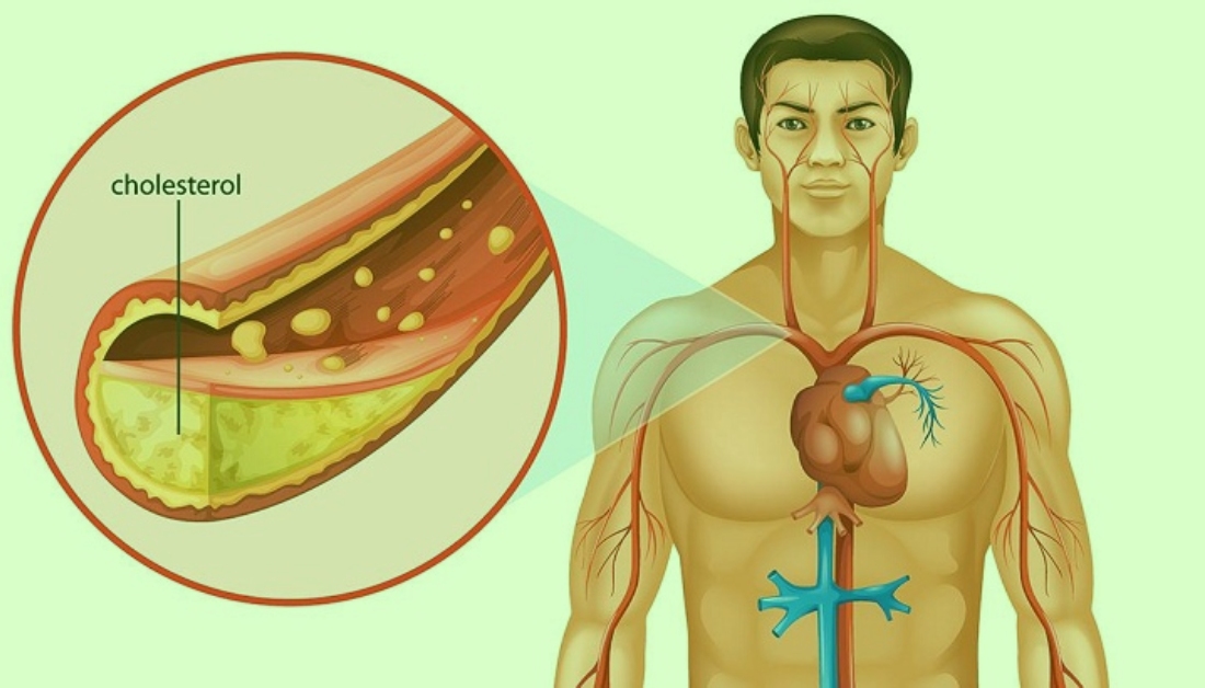 Bad Cholesterol Symptoms