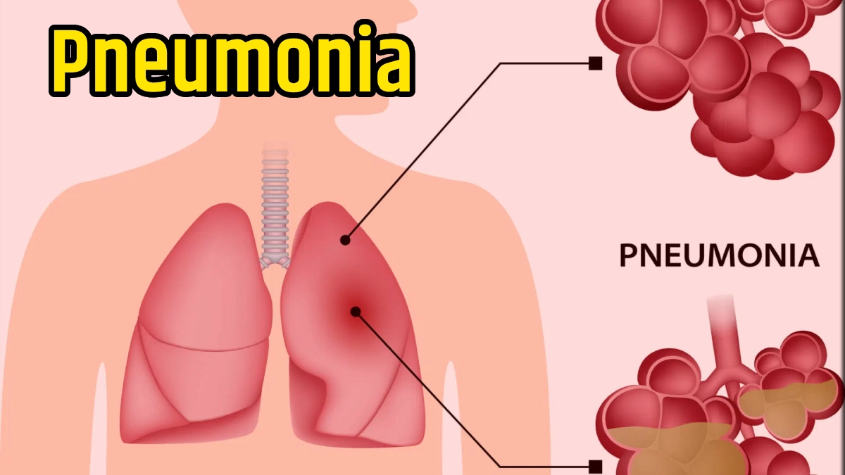 Pneumonia